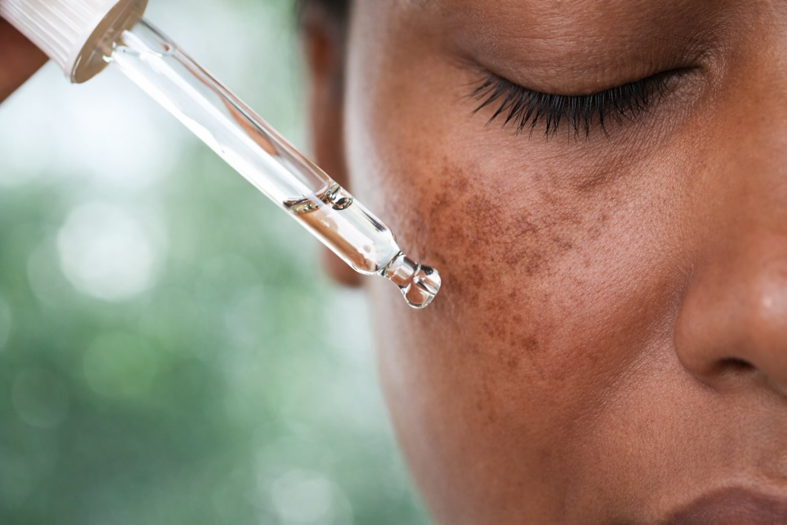 Melasma Sprechstunde Bonn | Pigmentflecken Behandlung | Alpha Skin